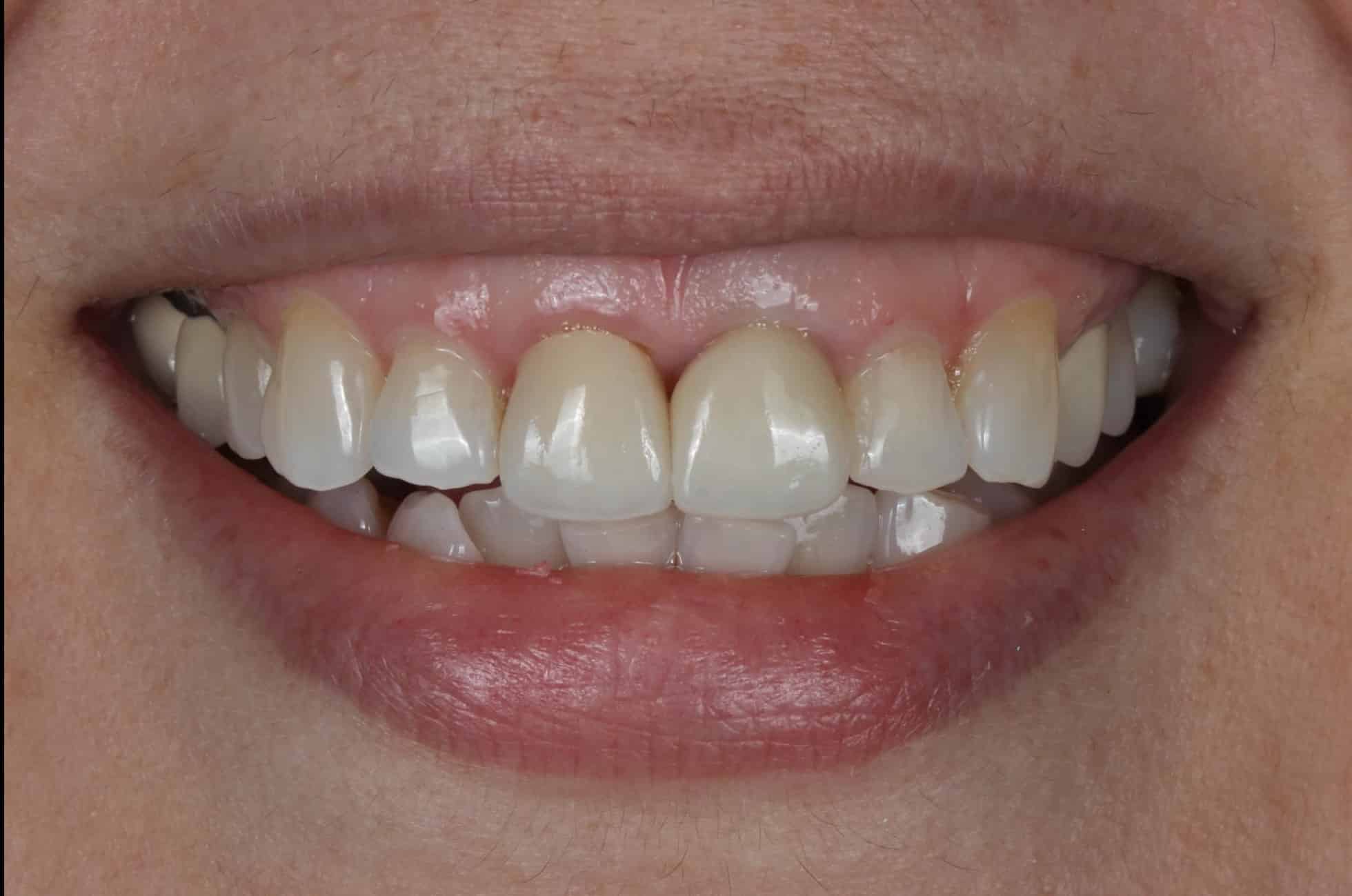 implant front teeth