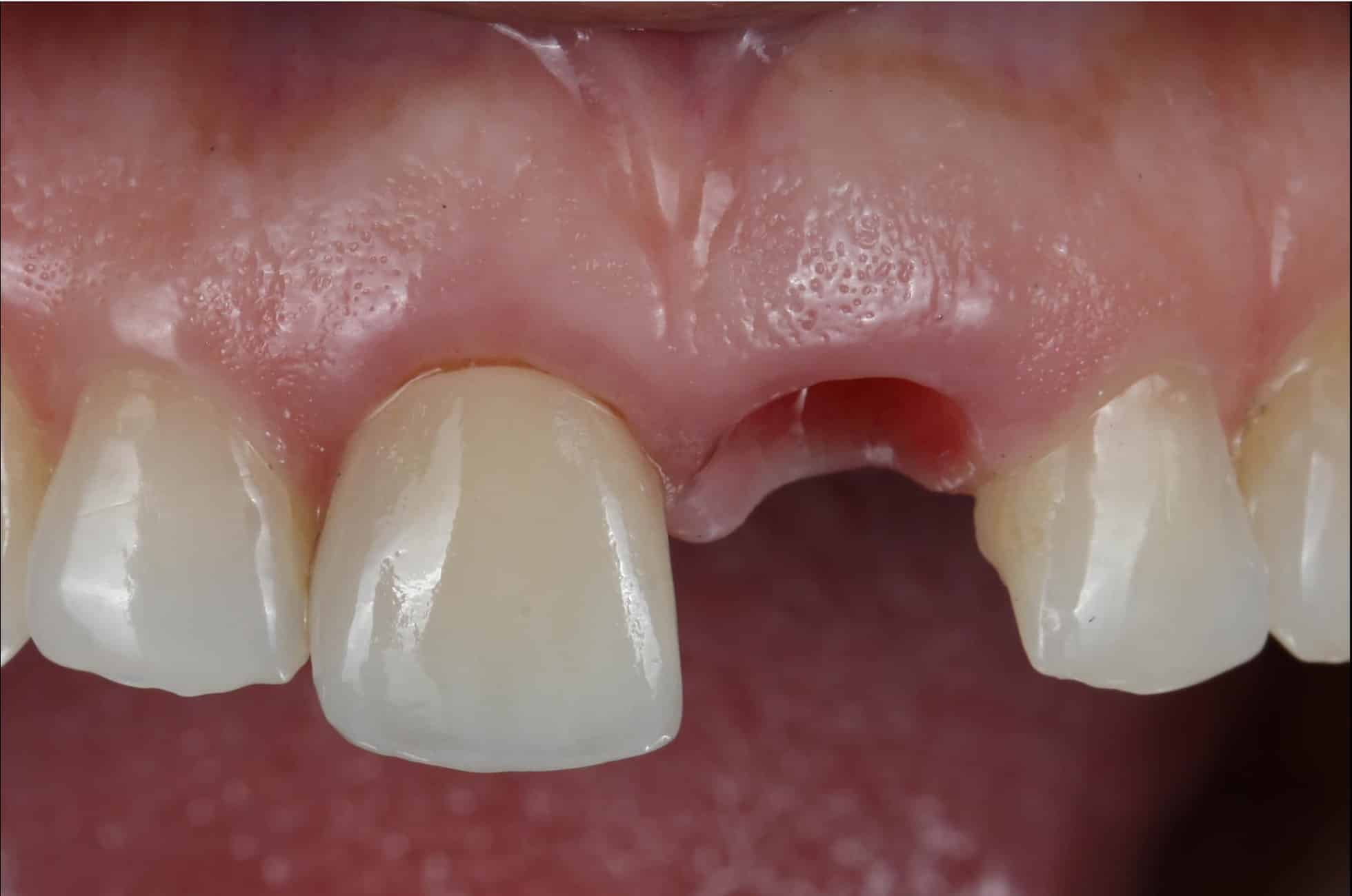 implant front teeth2