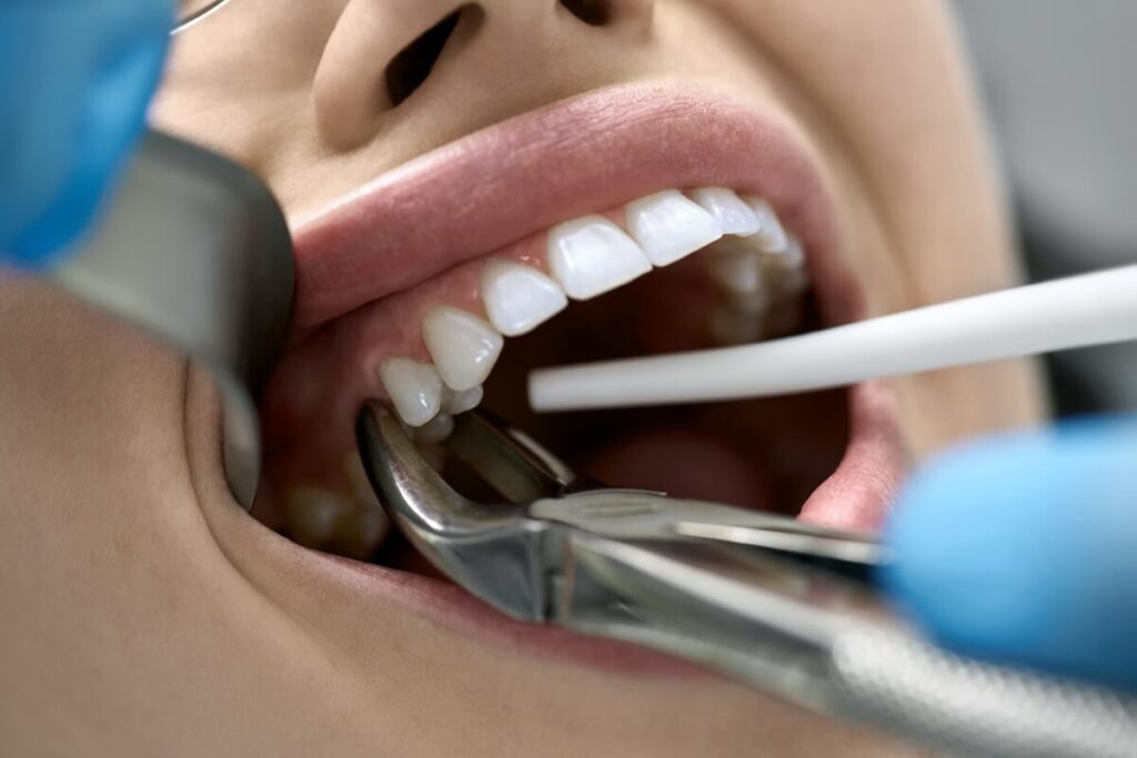 Dental extraction