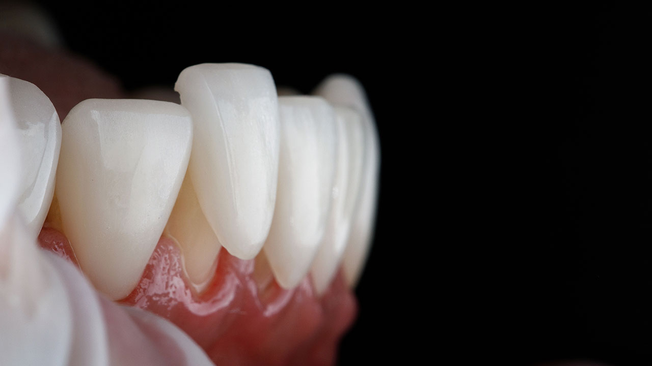 Eversmiles Dental | Porcelain Veneers in Pasadena, TX: What They Can Change and What to Expect