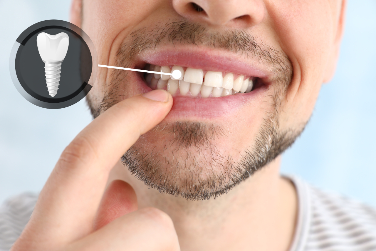Eversmiles Dental | How Dental Implants and Same-Day Services Can Restore Your Smile in Pasadena, TX
