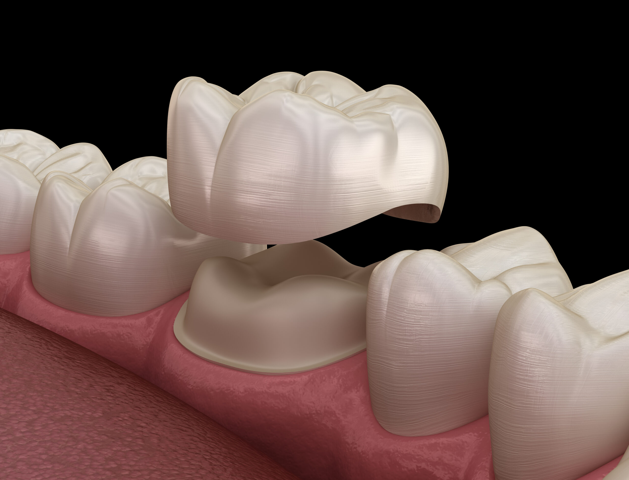 Eversmiles Dental | Dental Crowns After a Root Canal: How Pasadena, TX Patients Can Protect a Damaged Tooth