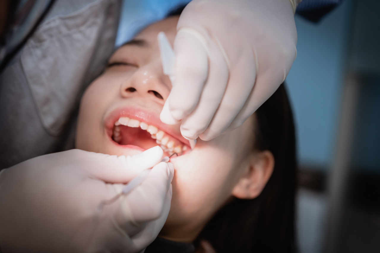 Eversmiles Dental | Same-Day Dental Extractions in Pasadena, TX: What Patients Should Know Before Treatment